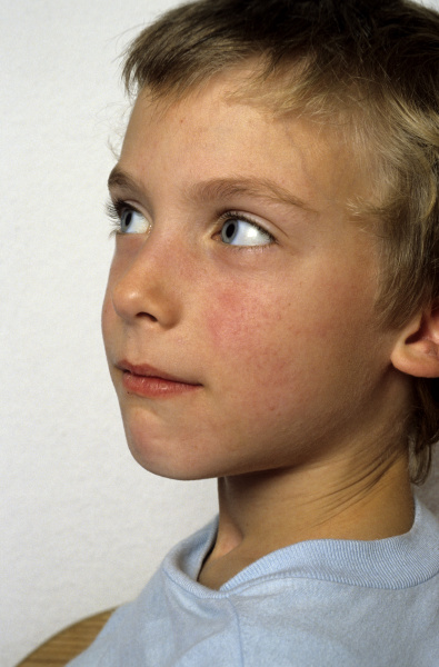 child with scarlet fever
