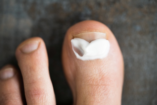 cream again fungus foot toenail infection