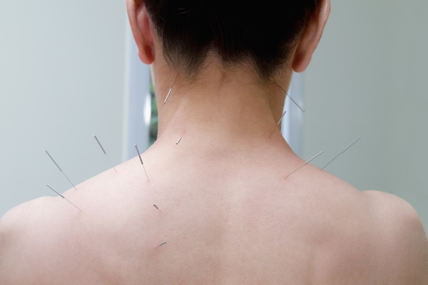 acupuncture needles on a person s