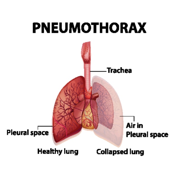 informative illustration of pneumothorax