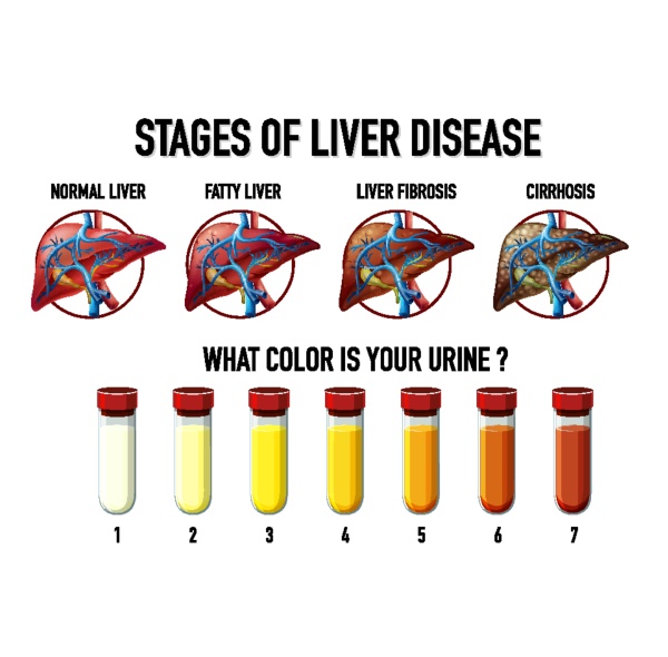 Stages of liver disease - Royalty free photo #30201264 | PantherMedia ...