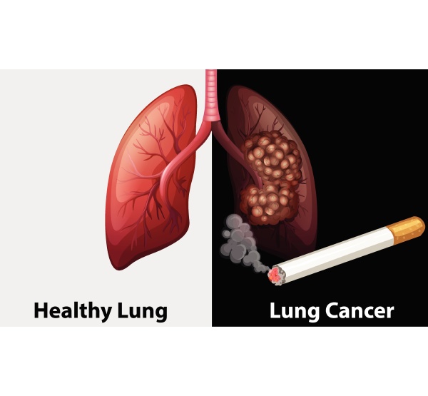 healthy lung against lung cancer diagram