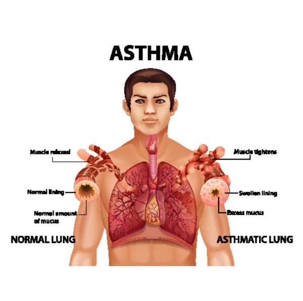comparison of healthy lung and asthmatic