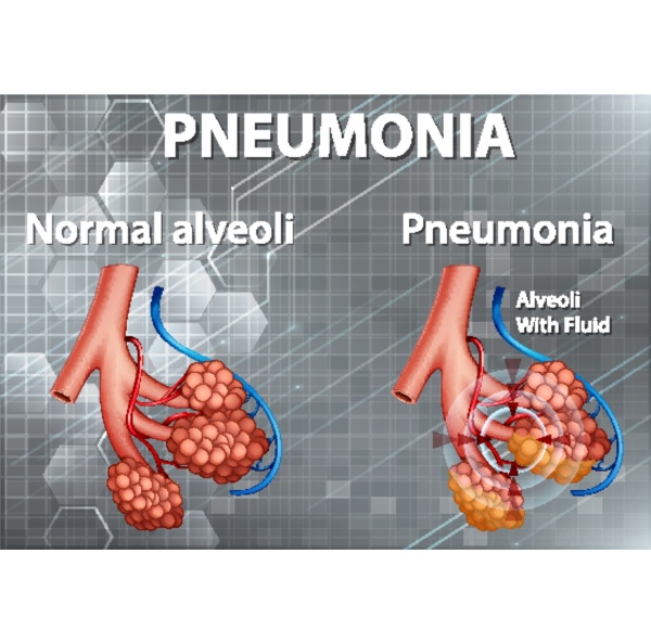 human anatomy showing pneumonia