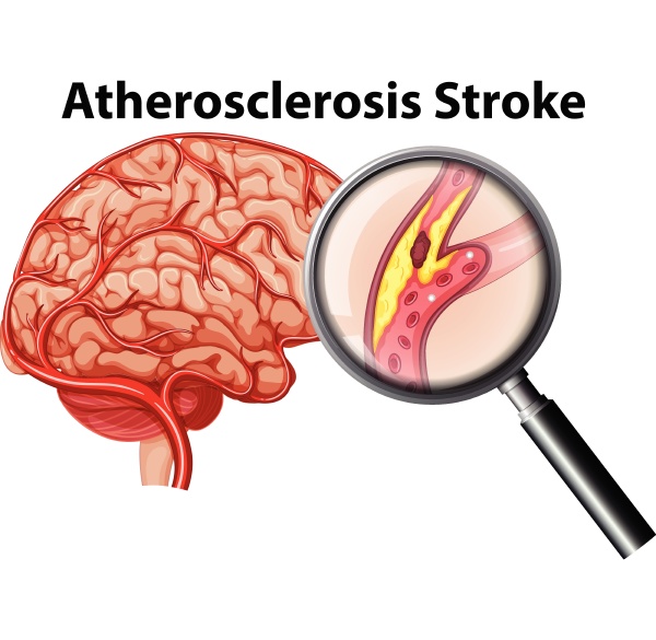 atherosclerosis stroke on white background