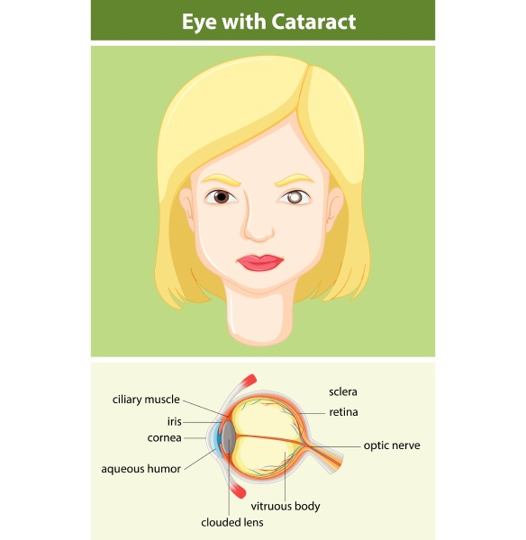 diagram showing eye with cataract