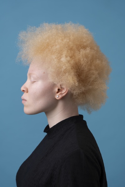 studio portrait of albino woman with