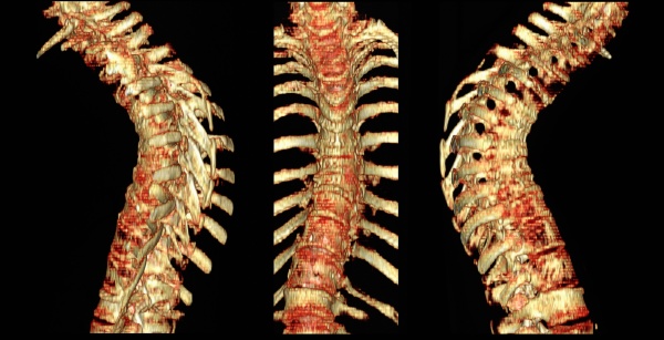 ct scan of thoracic spine with