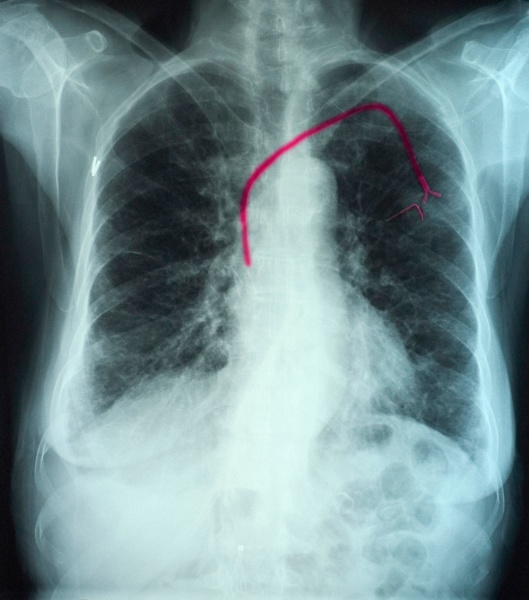 chest xray showing infusion port into