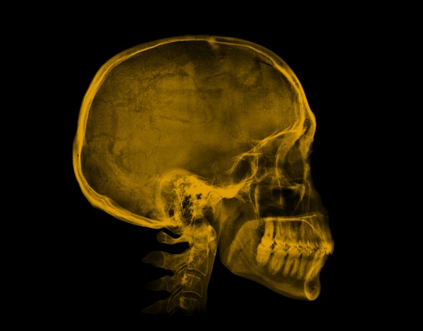 human skull yellow x ray
